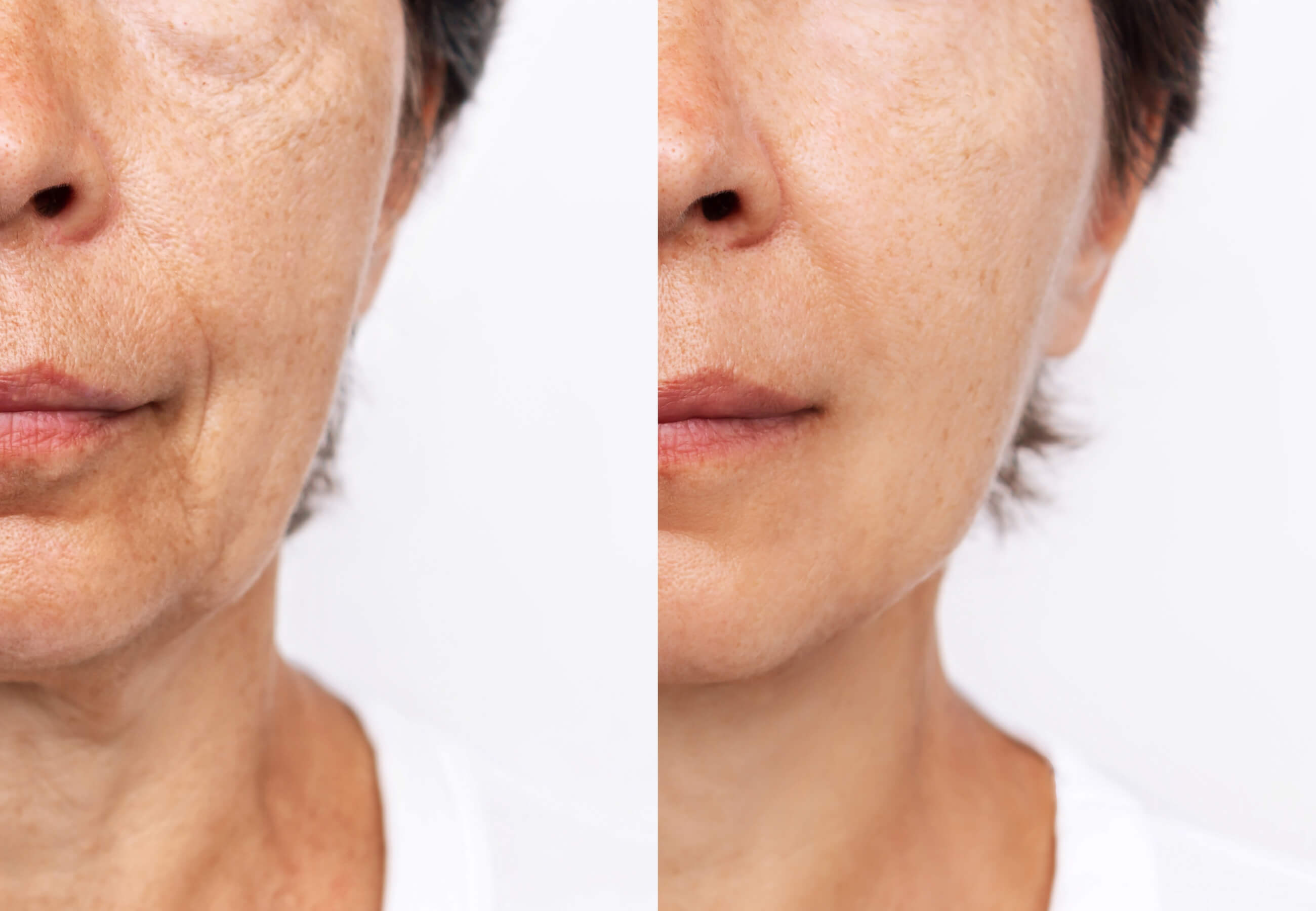 Reduction in Saggy Jowl and Contoured Jawline