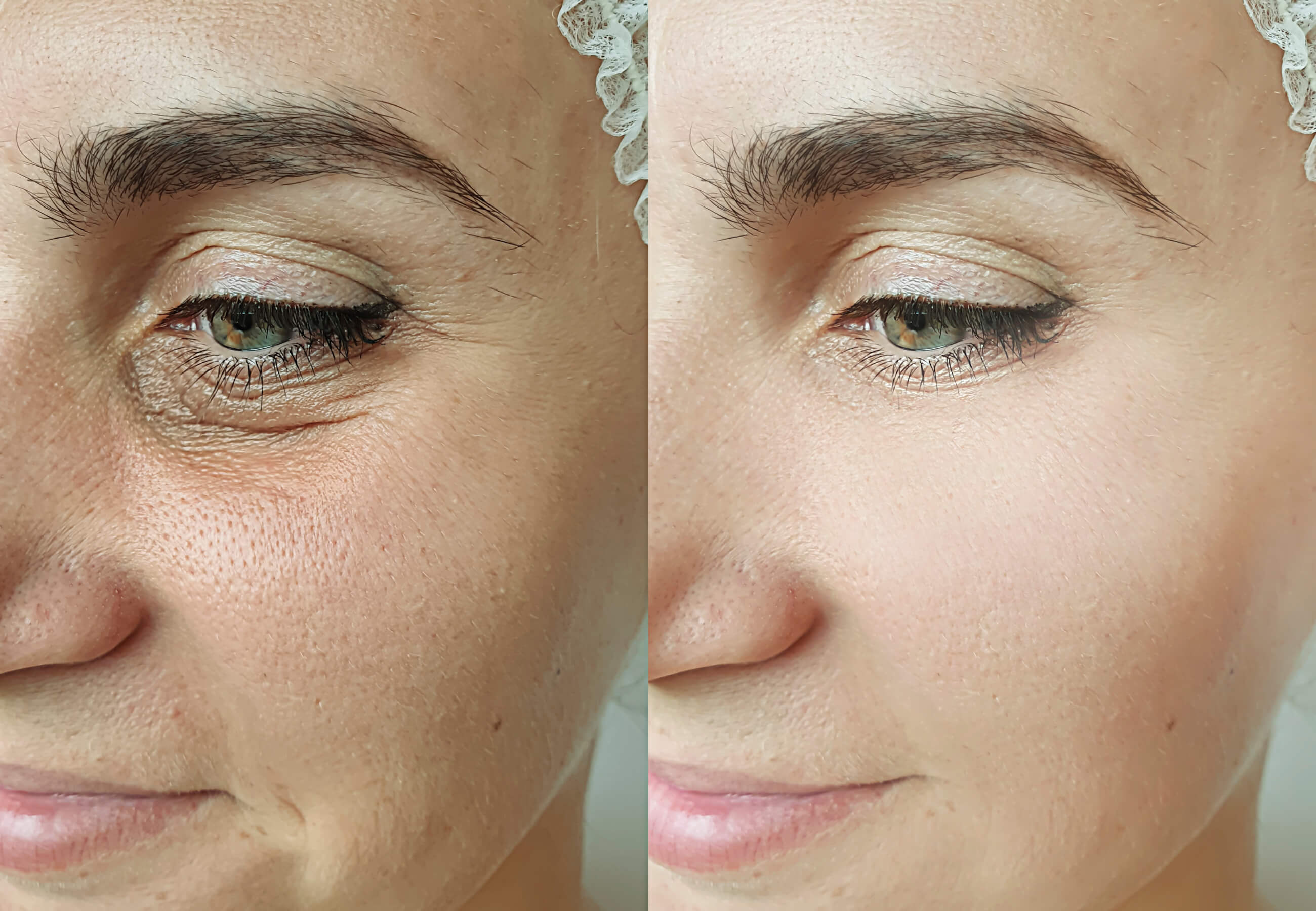Before and After - Smoother Skin Texture