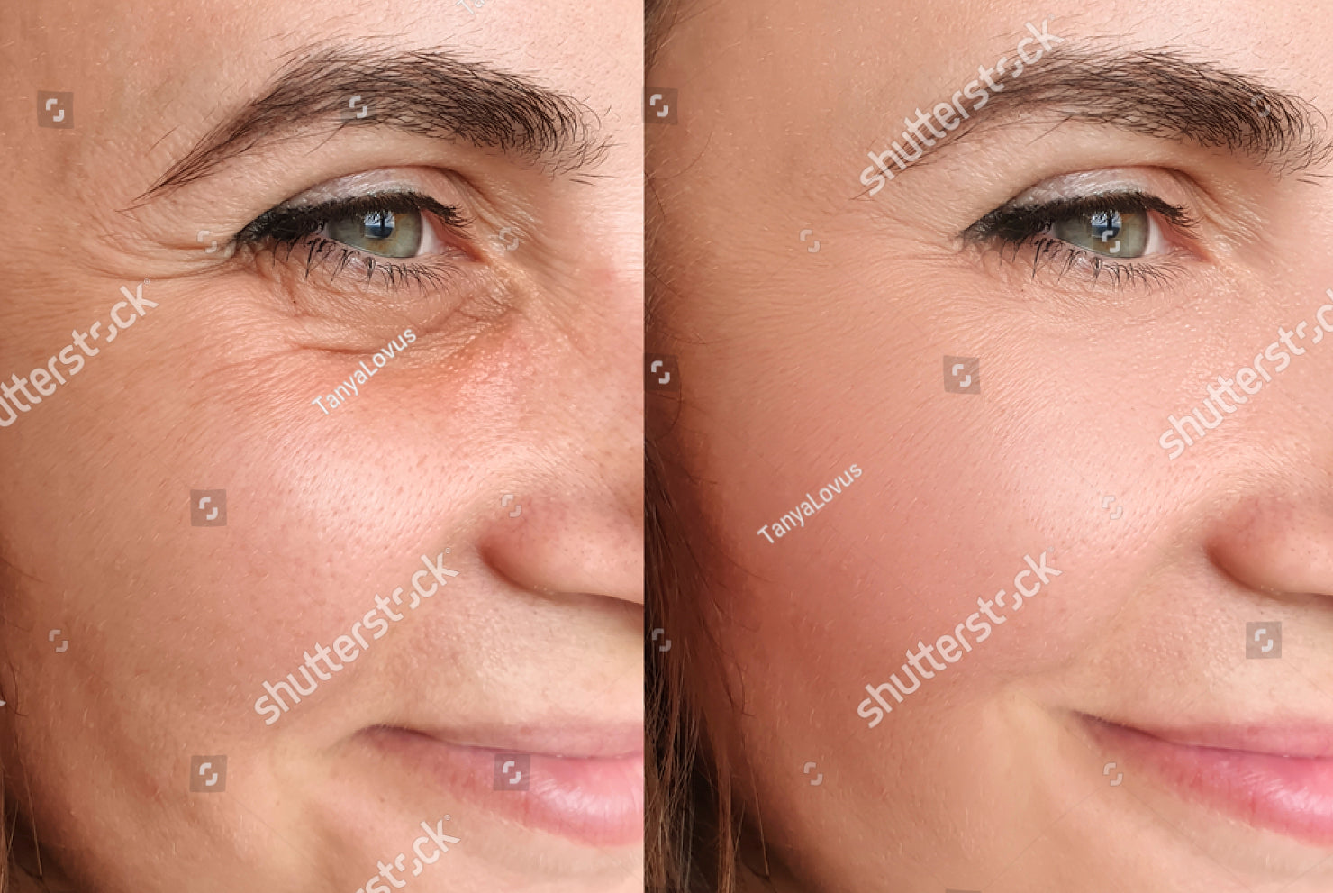 stock-photo-woman-face-wrinkles-after-treatment-1810031557_2