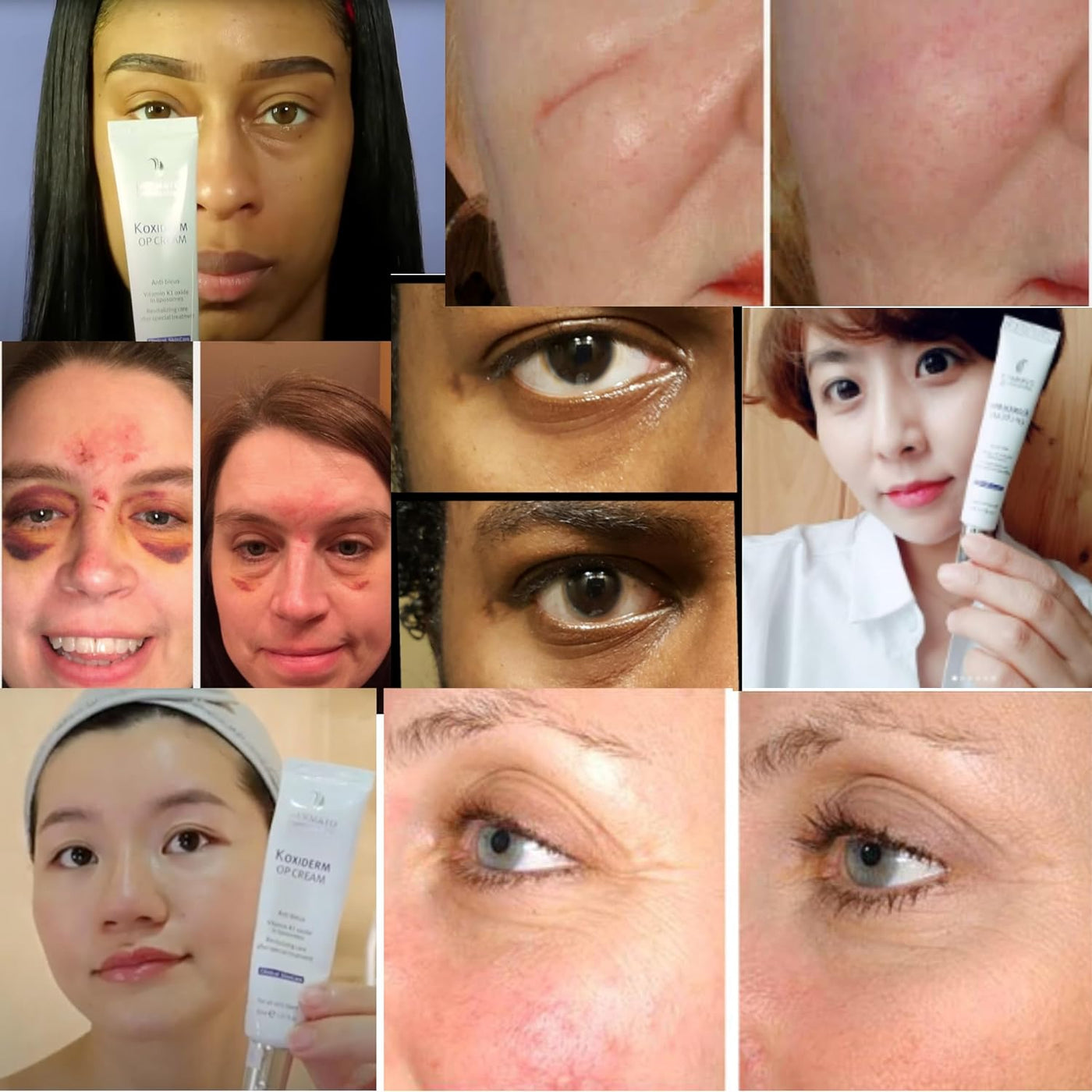 Vitamin K1 Cream Minimizing Appearance of Scars Dark Circles Bruises